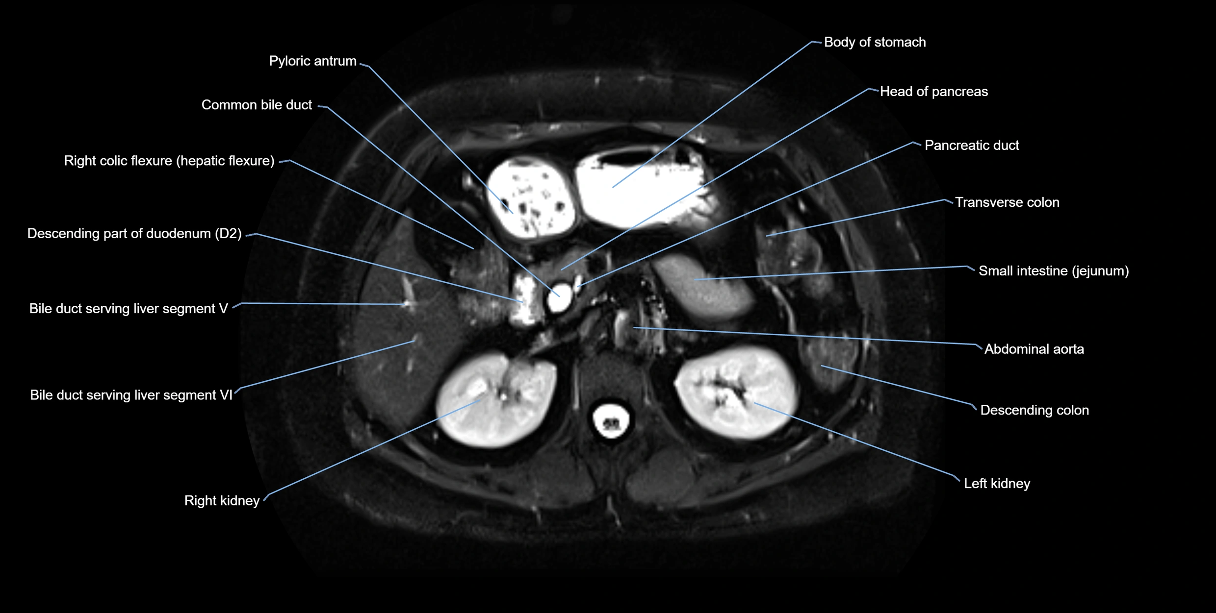 MRI MRCP axial cross sectional anatomy 3T radiology  image-img-10001-00023.webp